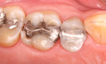 【国際】水俣条約締約国会議、2034年までに歯科用アマルガム廃止採択。採掘現場での水銀使用抑制強化も