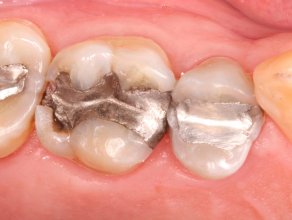 【国際】水俣条約締約国会議、2034年までに歯科用アマルガム廃止採択。採掘現場での水銀使用抑制強化も